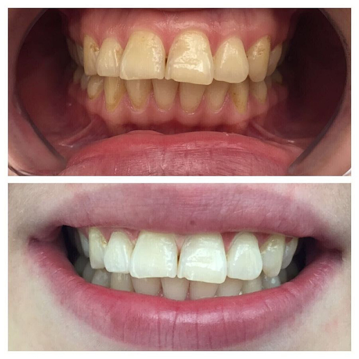 In Office Teeth Whitening System