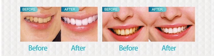 Two Patients Use Pro Teeth Whitening Kit